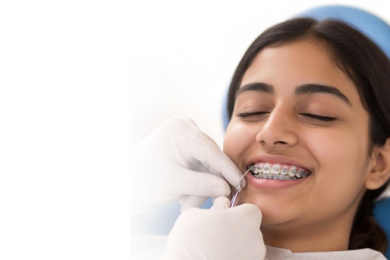 Ceramic braces in Mysore for discreet teeth alignment treatment at Umbrella Aesthetics dental clinic Jayalakshmipuram