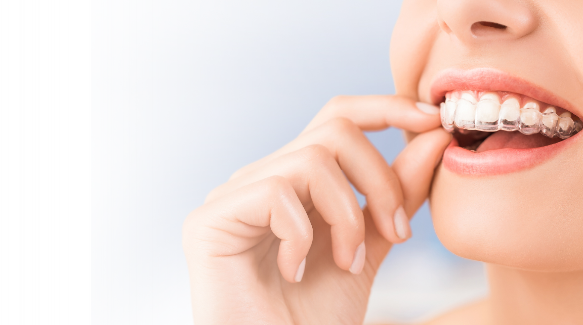 Invisalign aligners in Mysore for invisible teeth alignment treatment at Umbrella Aesthetics dental clinic Jayalakshmipuram