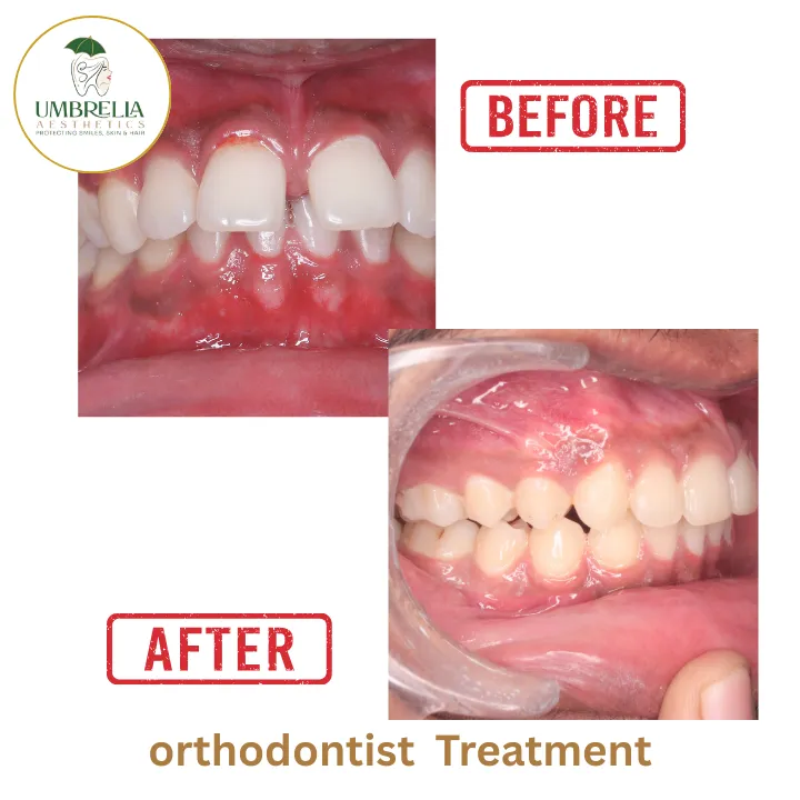 Before and after Invisalign aligners in Mysore showing teeth alignment correction at Umbrella Aesthetics dental clinic Jayalakshmipuram