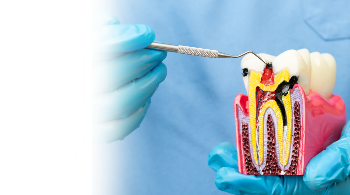 Root canal treatment Mysore performed at Umbrella Aesthetics dental clinic in Jayalakshmipuram for painless tooth infection treatment