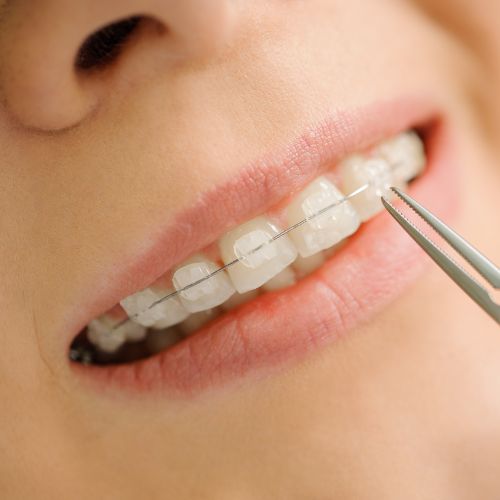 Adult Ceramic Braces Mysore