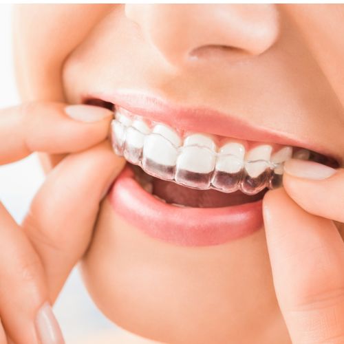 Aesthetic Orthodontic Braces Mysore