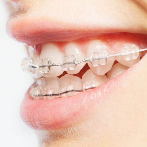 Clear Ceramic Braces Mysore