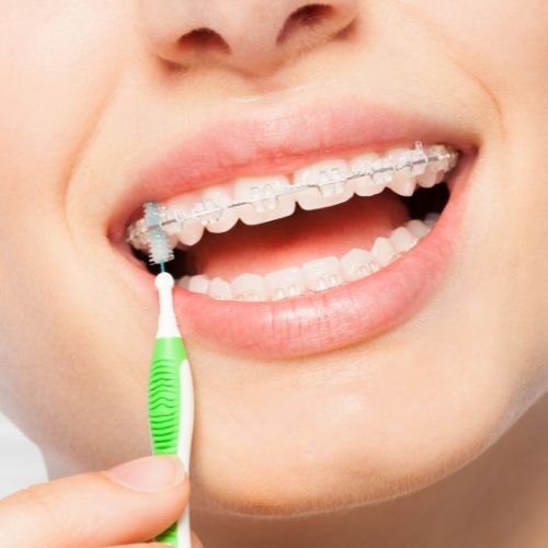 Self-Ligating Ceramic Braces Mysore