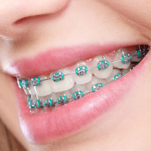 Tooth-Colored Braces Mysore