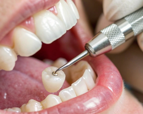 Fixed Dental Bridge Specialist in Mysore