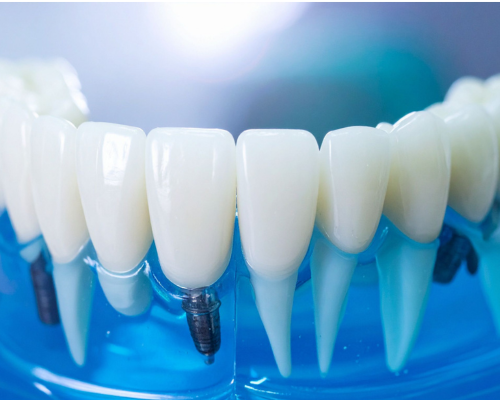 Full Ceramic Dental Crown Mysore