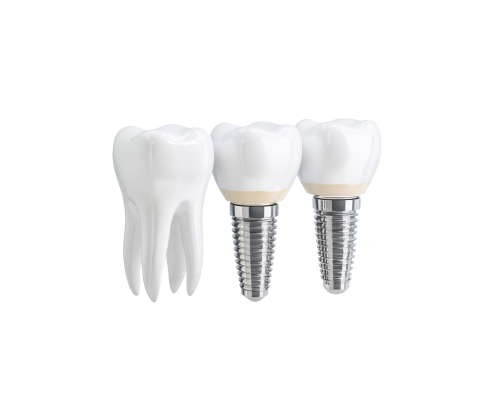 Porcelain Fused Metal Crown Treatment Mysore