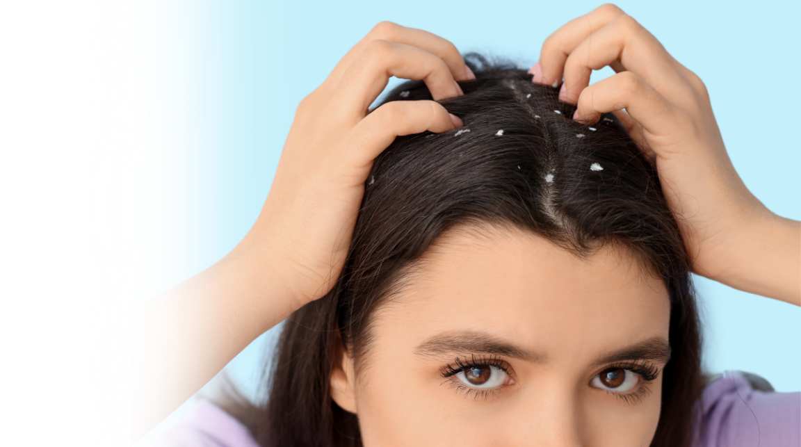 Dandruff Treatment Mysore