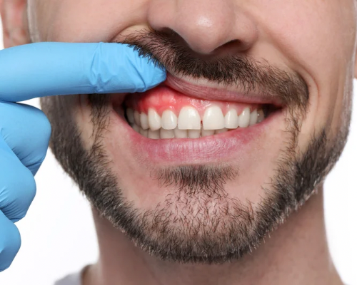 Gum Health Maintenance Cleaning Mysore