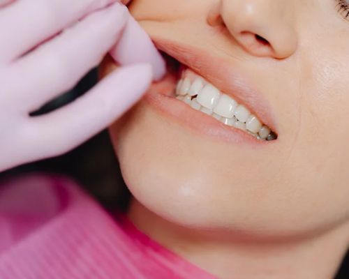 Tartar Removal Dental Clinic Mysore