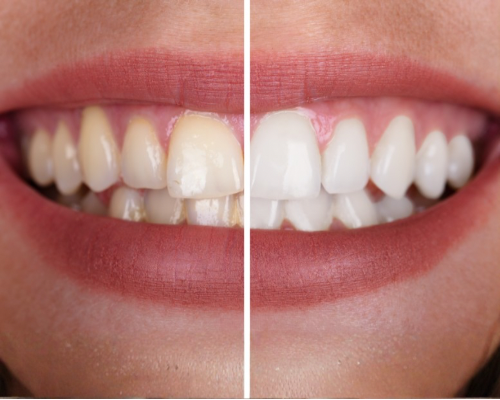 Professional Teeth Polishing in Mysore