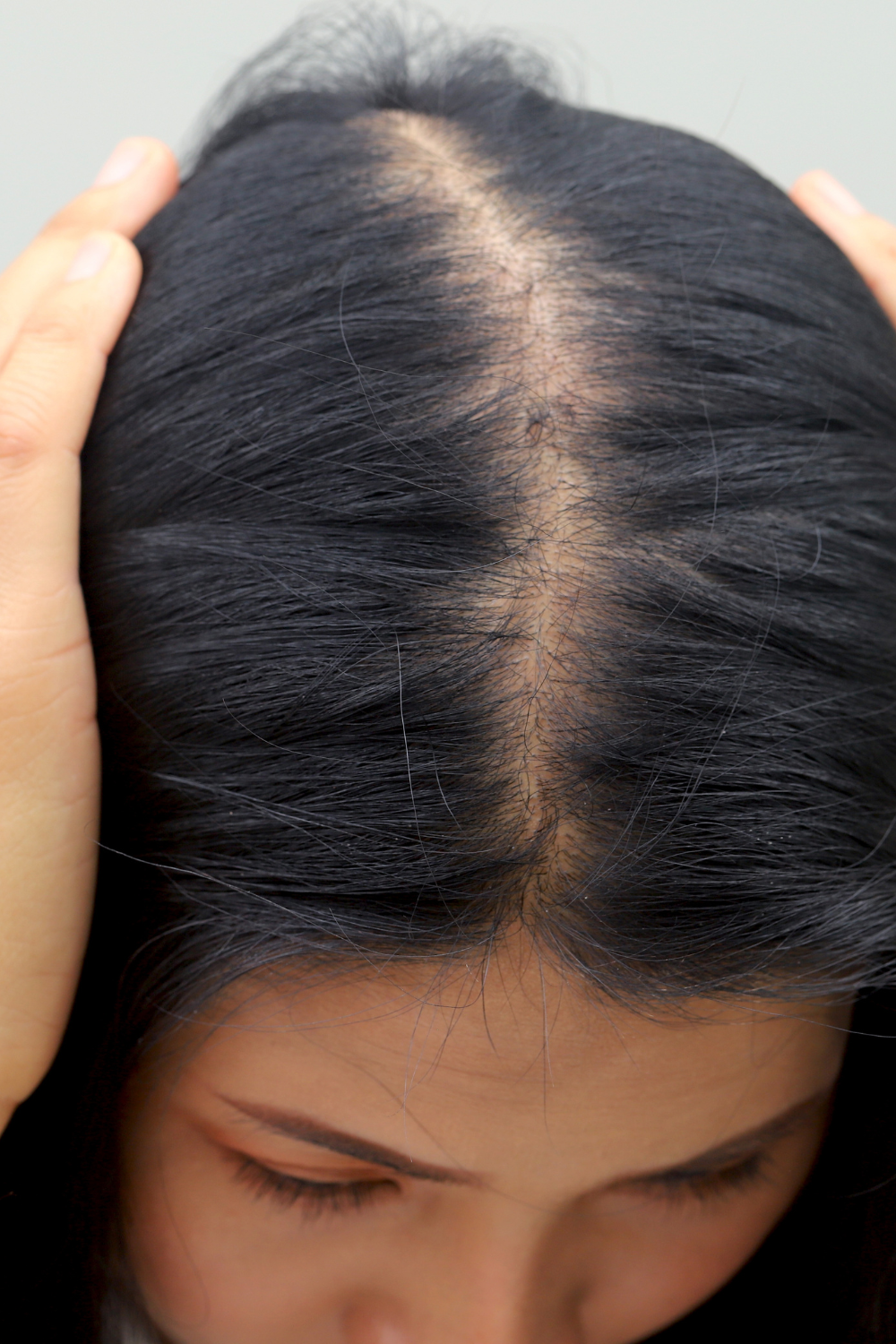 Hair Fall Treatment Mysore
