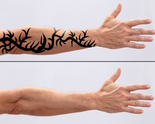 Black Ink Tattoo Removal Mysore