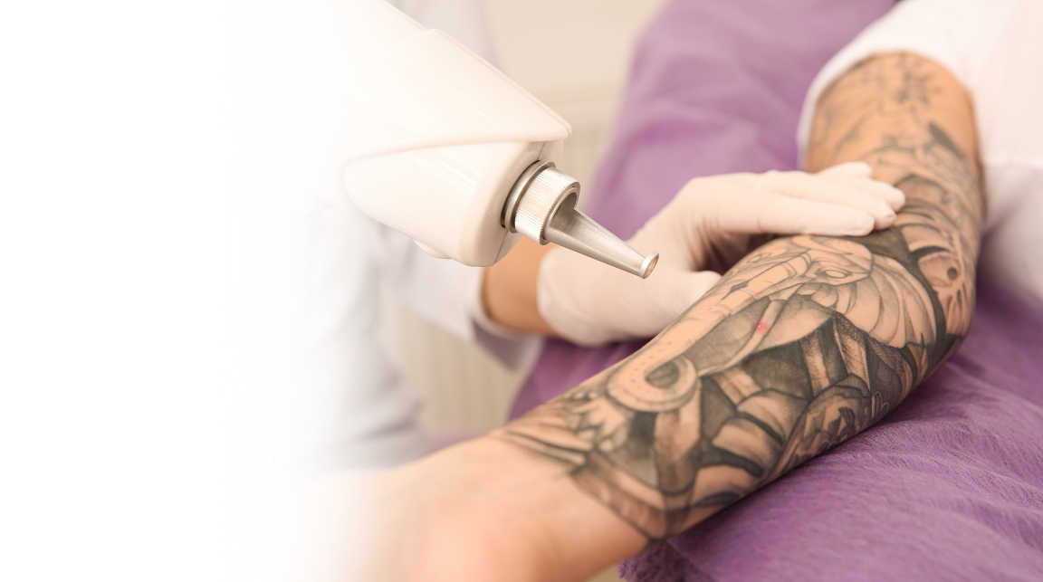 Laser Tattoo Removal Mysore