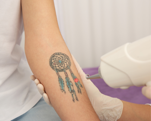 Multi Color Tattoo Removal Mysore