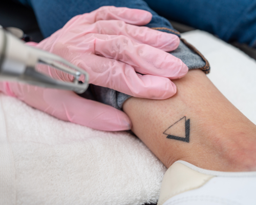 Tattoo Fading Mysore