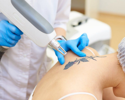 Q-Switched Laser Mysore