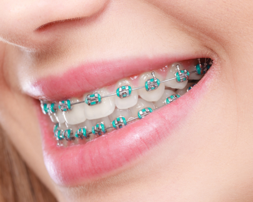 Elastic Color Bands Mysore