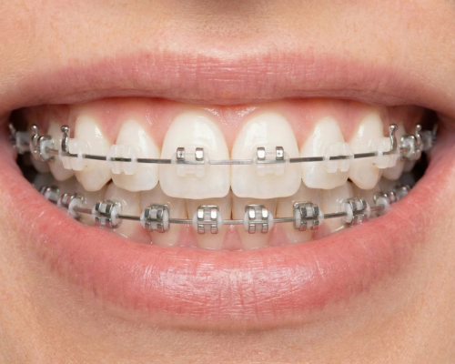 Self-Ligating Braces Mysore