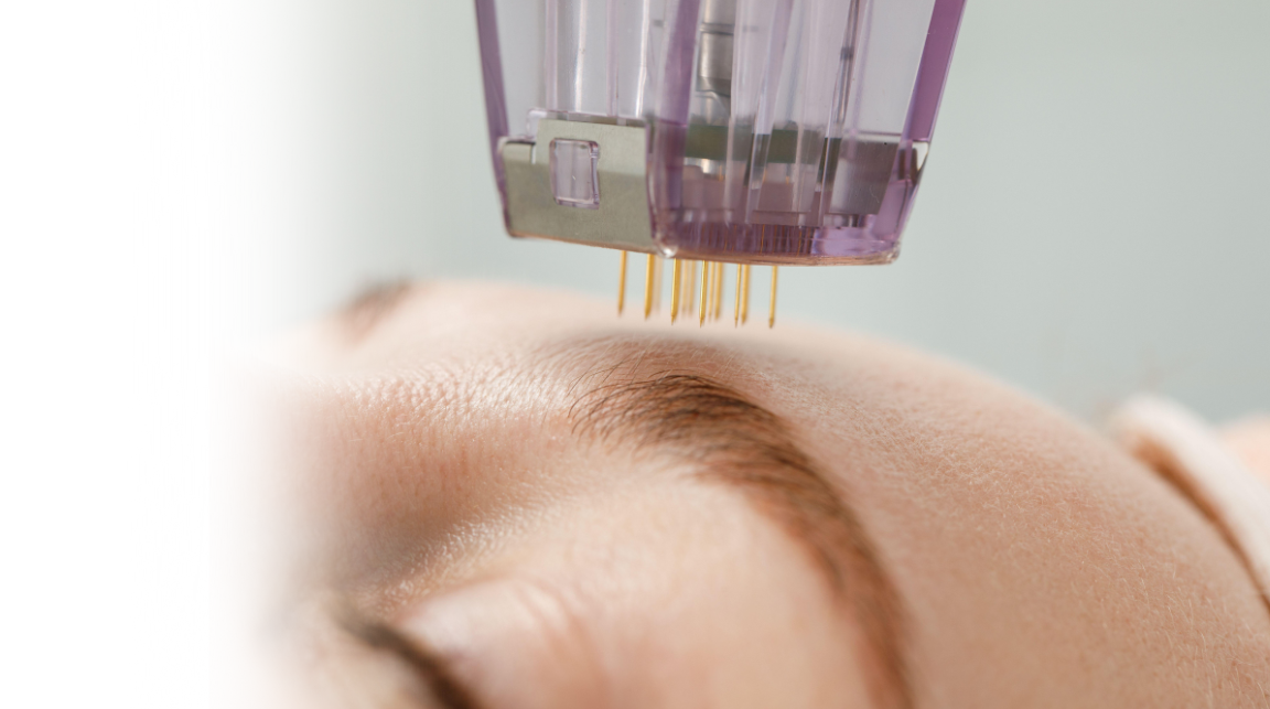 Microneedling Treatment Mysore