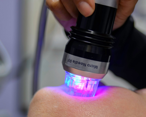 RF Microneedling Mysore