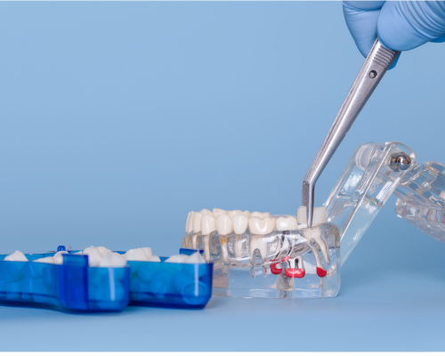 Post Core Crown Placement Mysore