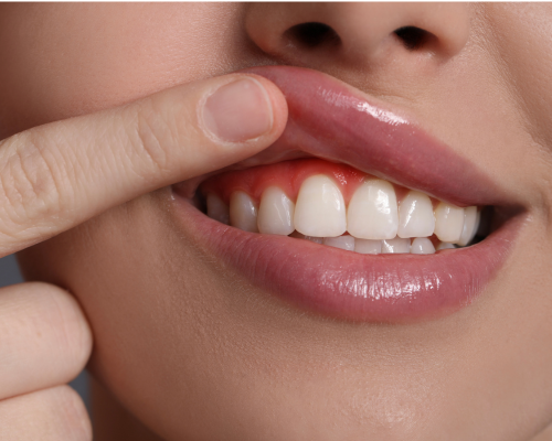 Gum Contouring Mysore