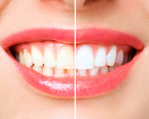 Teeth Whitening Mysore