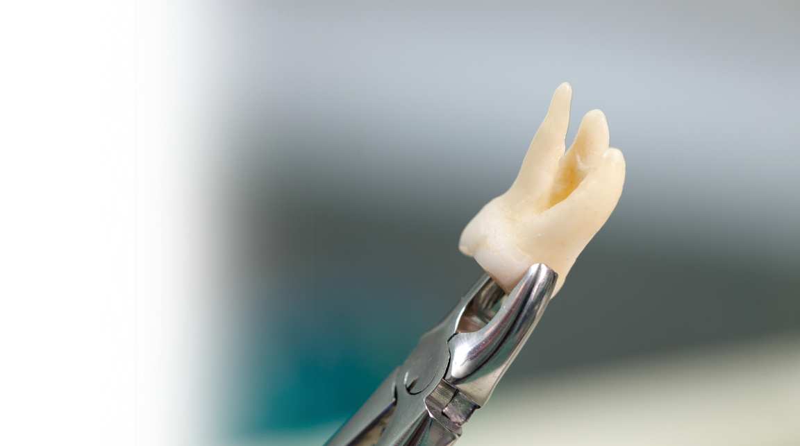 Tooth Extraction Mysore