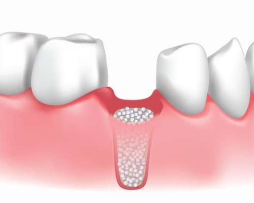 Socket Preservation Mysore