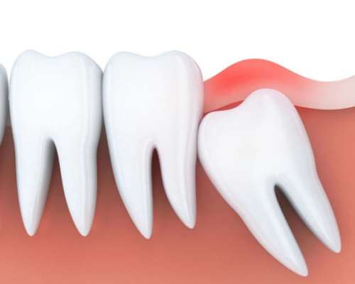 Wisdom Tooth Removal Mysore