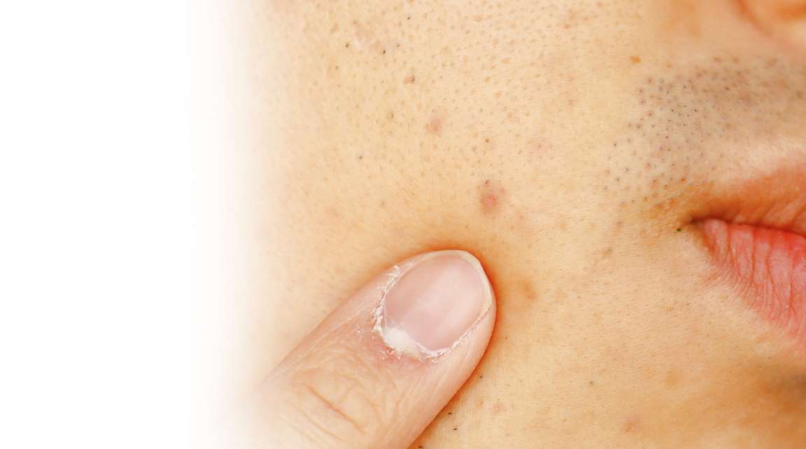 Advanced acne scar treatment using laser and microneedling performed by dermatologist in Mysore