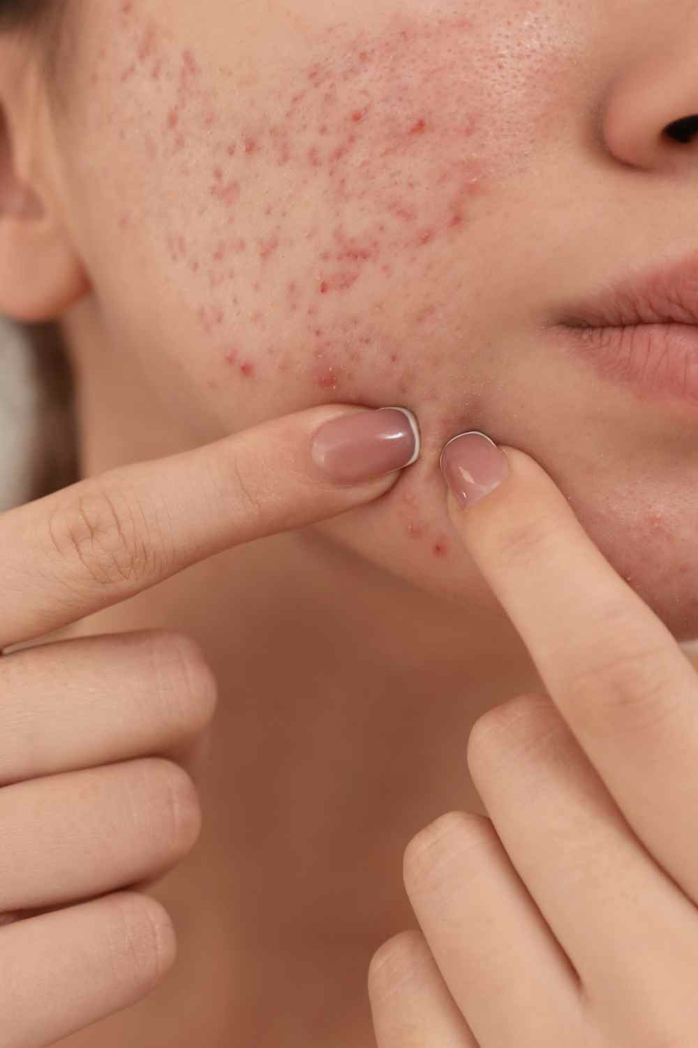 Pimple Scar Removal Mysore