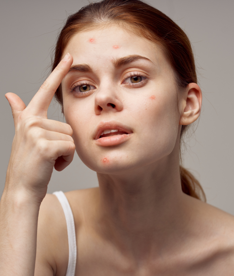 Untitled design (10) Acne Scar Treatment