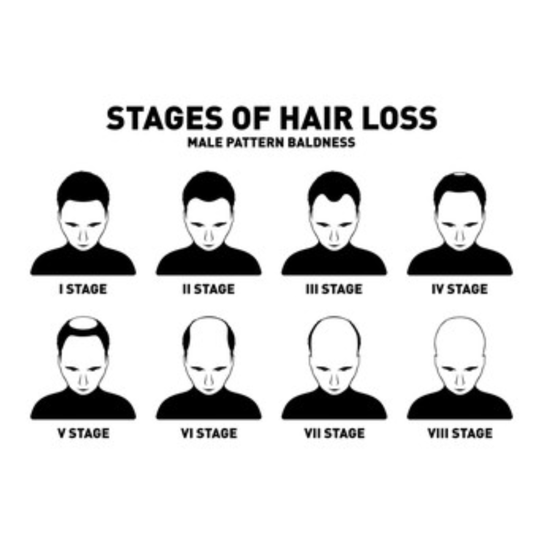 hair transplant cost in mysore